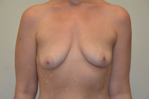Breast-Lift-and-Augmentation-12 | Before Breast Lift and Augmentation