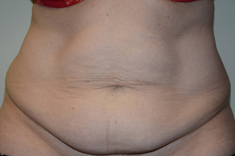 Tummy-Tuck-15 | Before Tummy Tuck