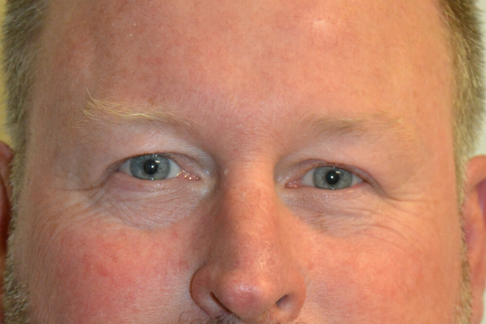 Eyelid-Surgery-12 | Before Eyelid Surgery