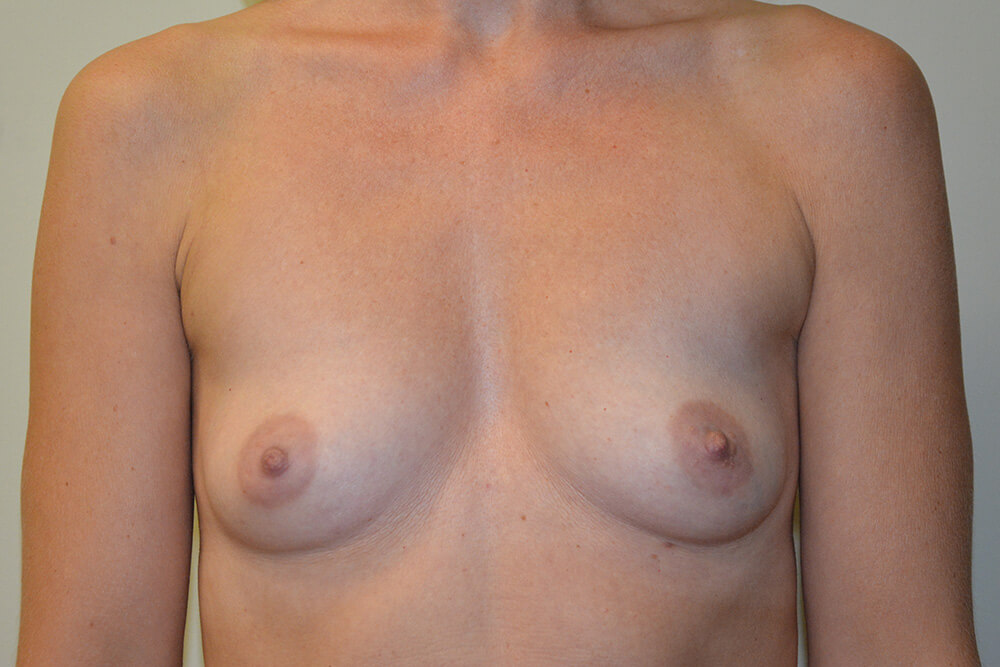 Breast-Augmentation-12 | Before Breast Augmentation