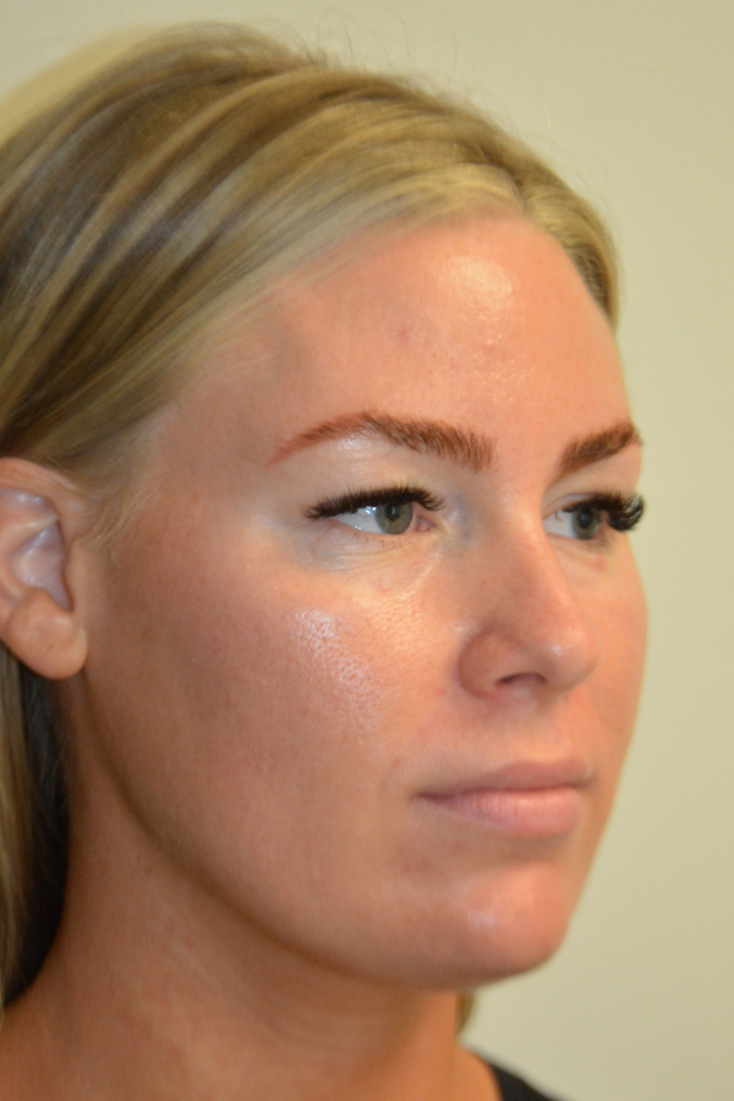 Liposuction-12 | Before Liposuction 2