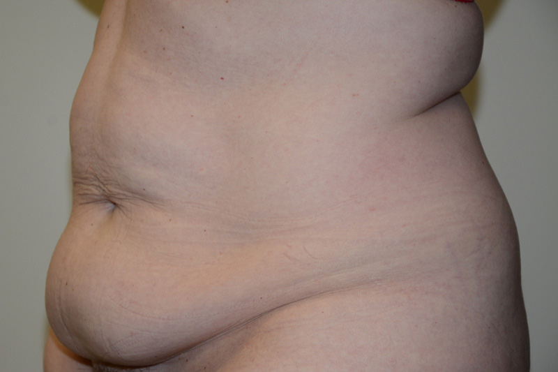 Tummy-Tuck-15 | Before Tummy Tuck 2