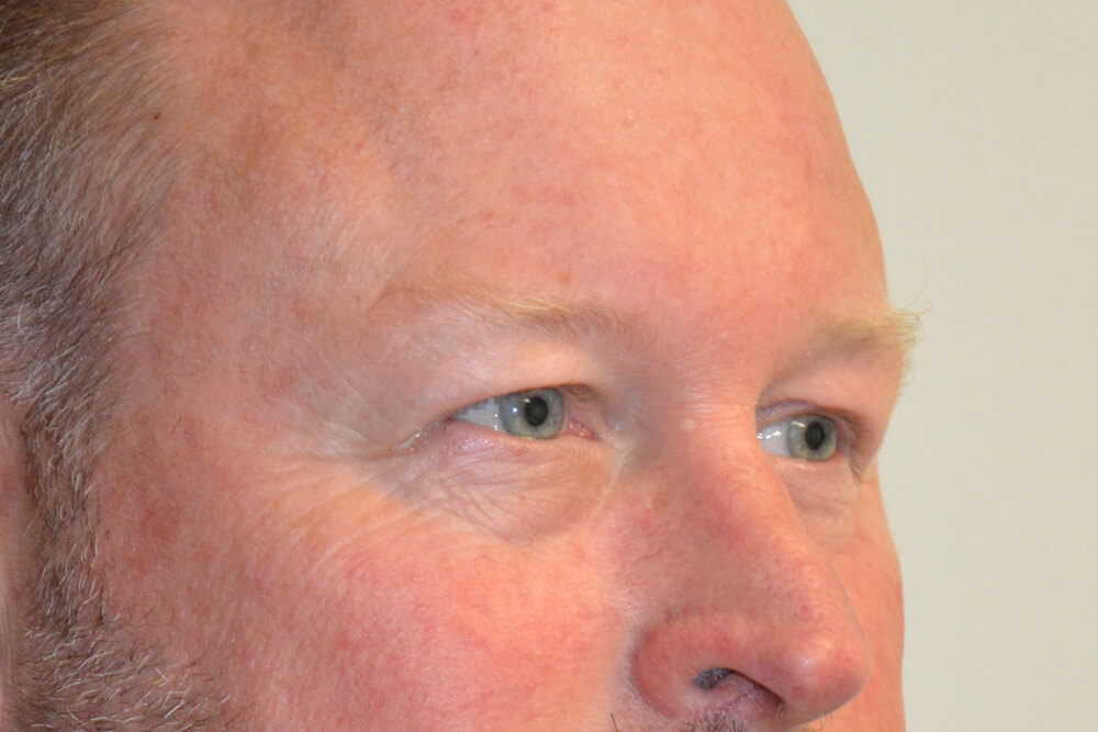 Eyelid-Surgery-12 | Before Eyelid Surgery 2