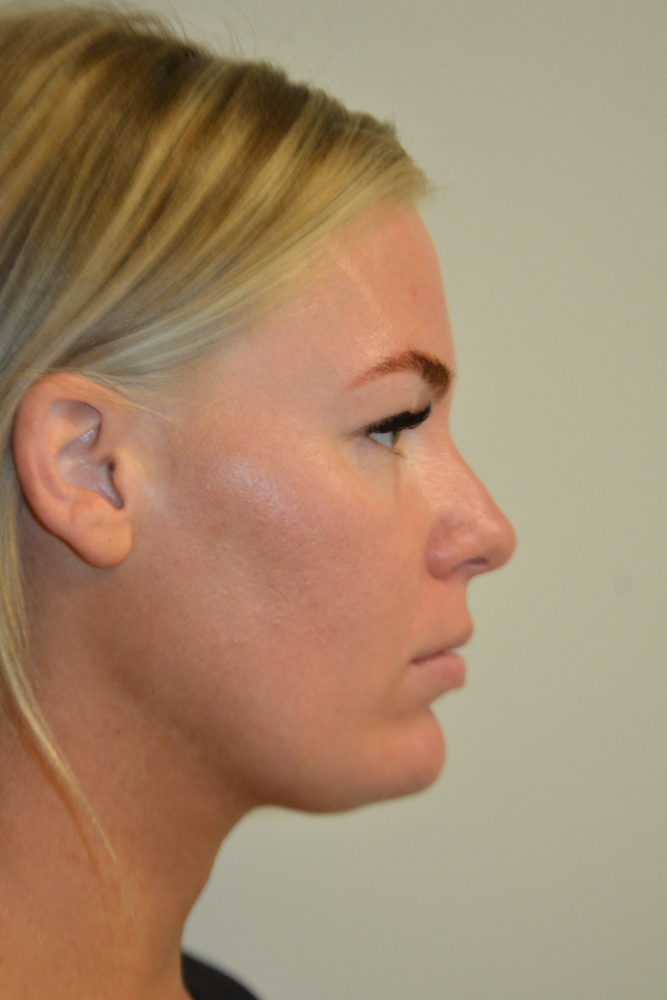 Liposuction-12 | Before Liposuction 3
