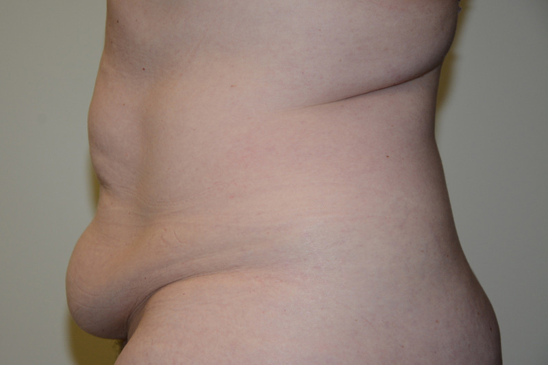 Tummy-Tuck-15 | Before Tummy Tuck 3