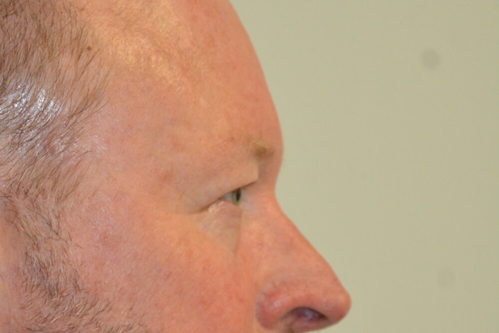 Eyelid-Surgery-12 | Before Eyelid Surgery 3