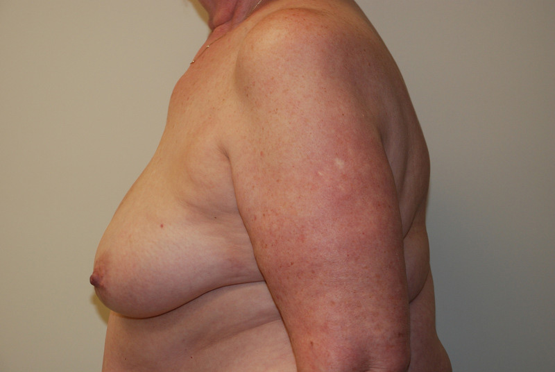 Breast-Reconstruction-Tissue-Expander-12 | Before Breast Reconstruction Tissue Expanders 3