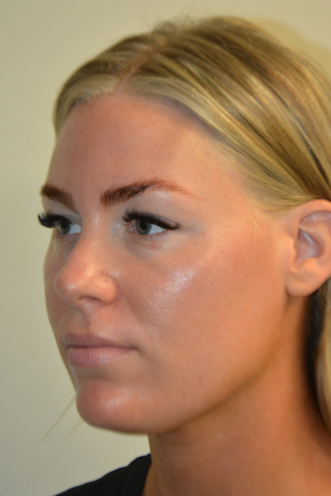Liposuction-12 | Before Liposuction 4