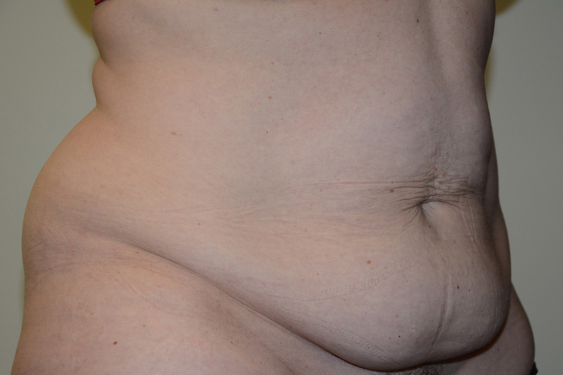Tummy-Tuck-15 | Before Tummy Tuck 4