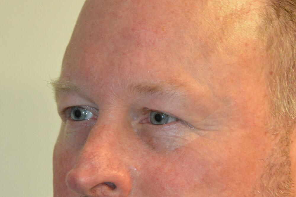 Eyelid-Surgery-12 | Before Eyelid Surgery 4