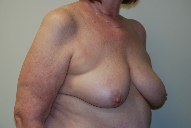 Breast-Reconstruction-Tissue-Expander-12 | Before Breast Reconstruction Tissue Expanders 4