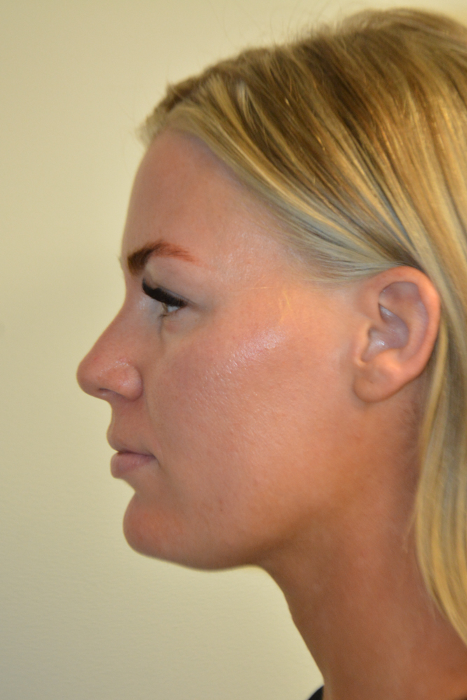 Liposuction-12 | Before Liposuction 5