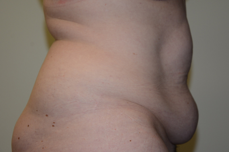 Tummy-Tuck-15 | Before Tummy Tuck 5