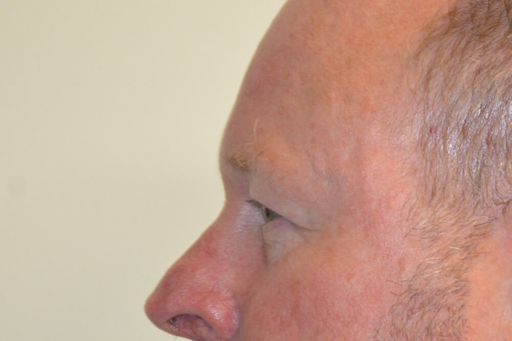 Eyelid-Surgery-12 | Before Eyelid Surgery 5