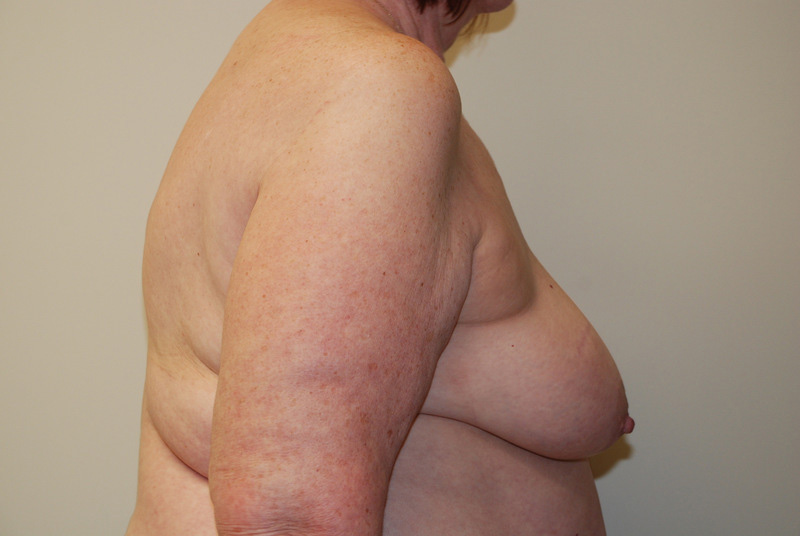 Breast-Reconstruction-Tissue-Expander-12 | Before Breast Reconstruction Tissue Expanders 5
