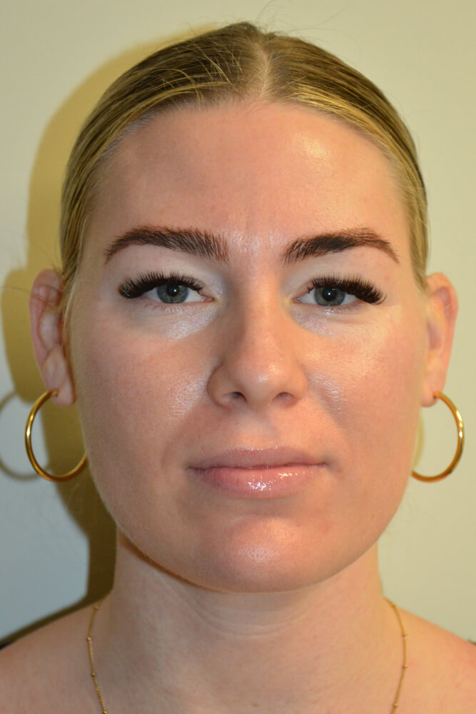 Liposuction-12 | After Liposuction
