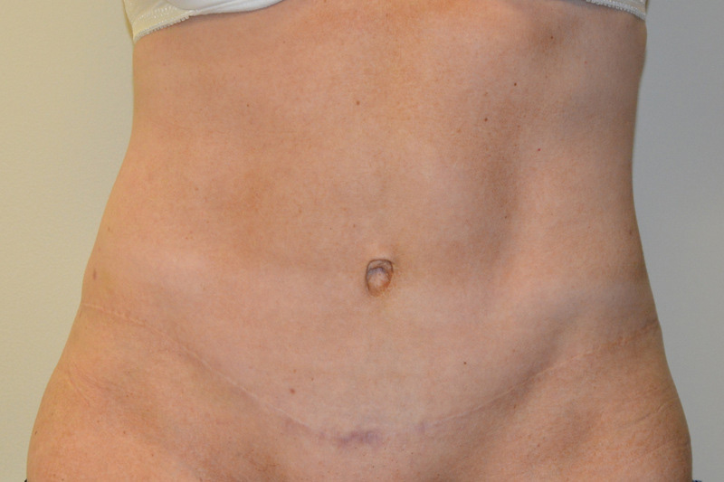 Tummy-Tuck-15 | After Tummy Tuck