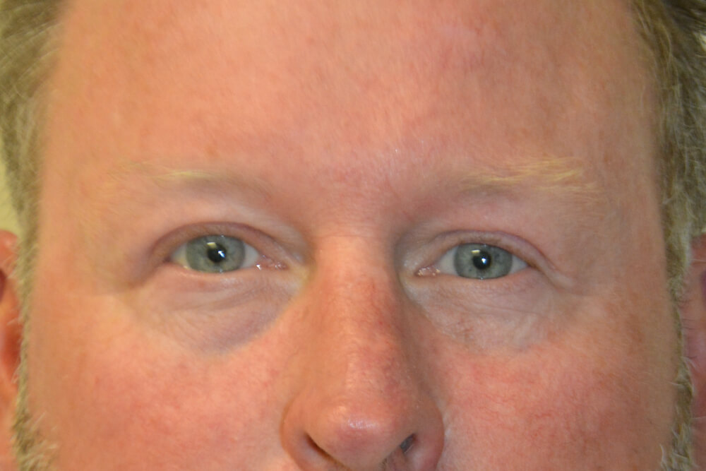 Eyelid-Surgery-12 | After Eyelid Surgery