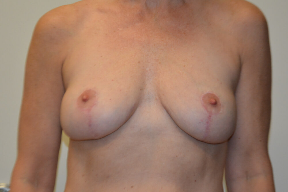 Breast-Lift-11 | After Breast Lift