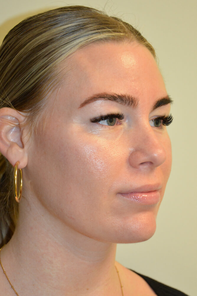 Liposuction-12 | After Liposuction 2