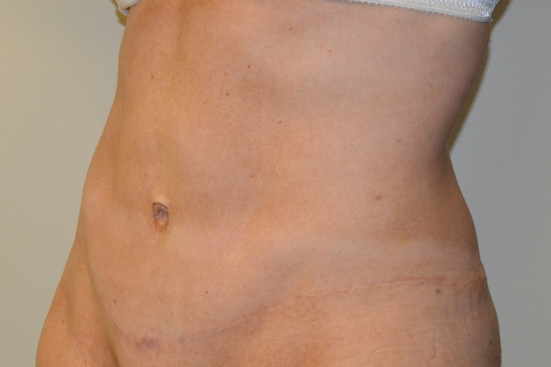 Tummy-Tuck-15 | After Tummy Tuck 2