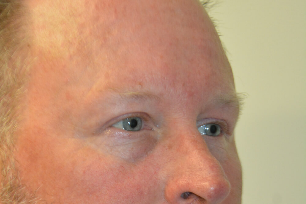 Eyelid-Surgery-12 | After Eyelid Surgery 2