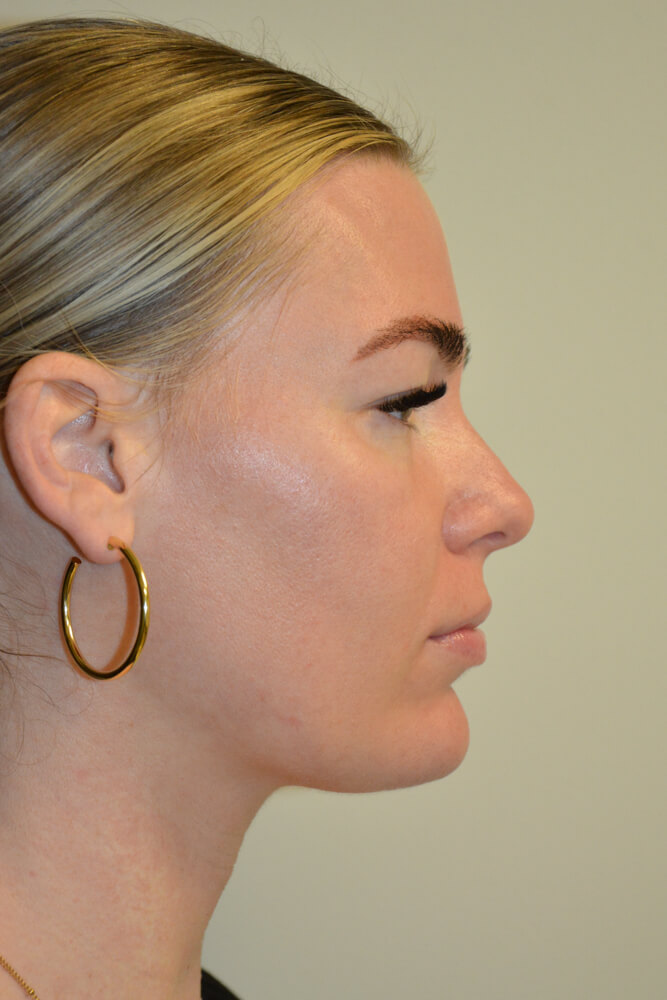 Liposuction-12 | After Liposuction 3
