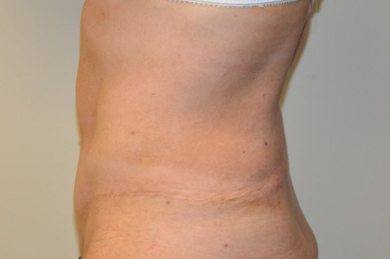 Tummy-Tuck-15 | After Tummy Tuck 3