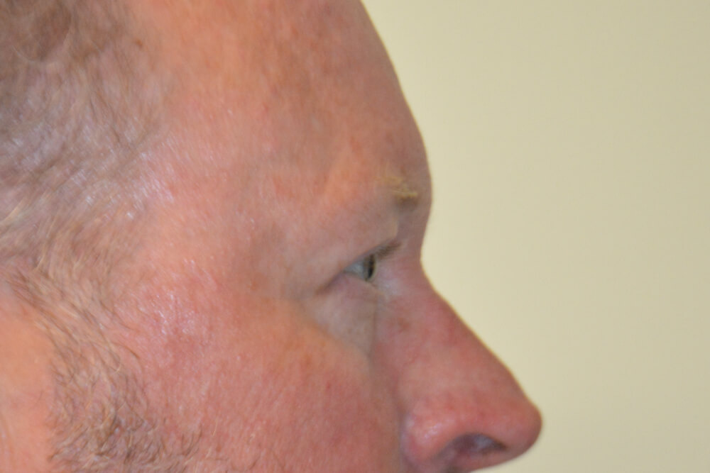 Eyelid-Surgery-12 | After Eyelid Surgery 3