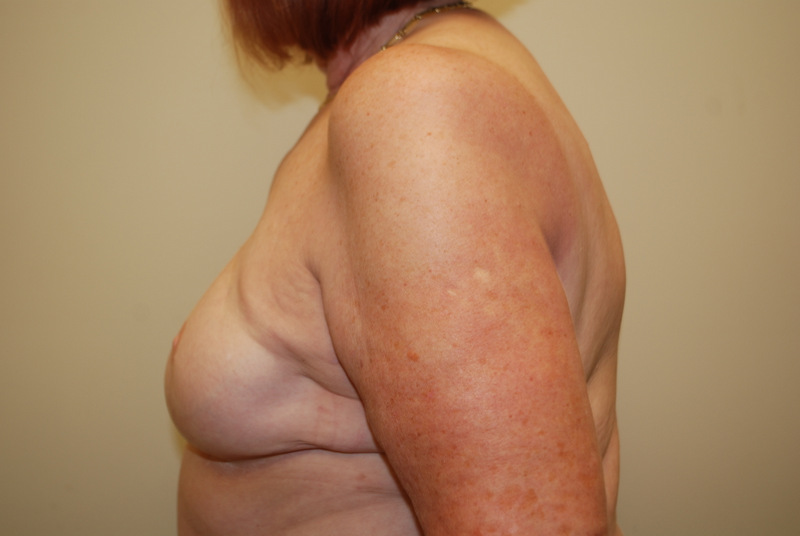 Breast-Reconstruction-Tissue-Expander-12 | After Breast Reconstruction Tissue Expanders 3