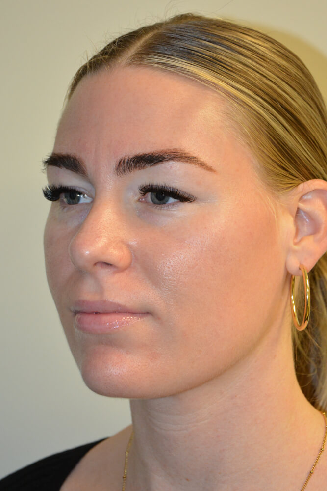 Liposuction-12 | After Liposuction 4