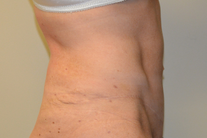 Tummy-Tuck-15 | After Tummy Tuck 5