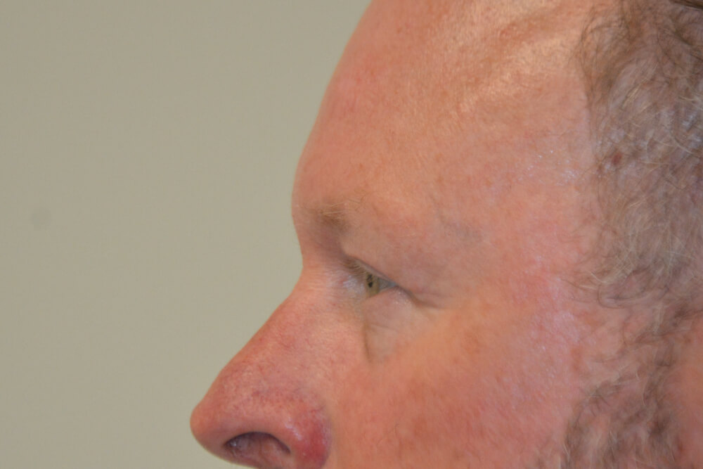 Eyelid-Surgery-12 | After Eyelid Surgery 5