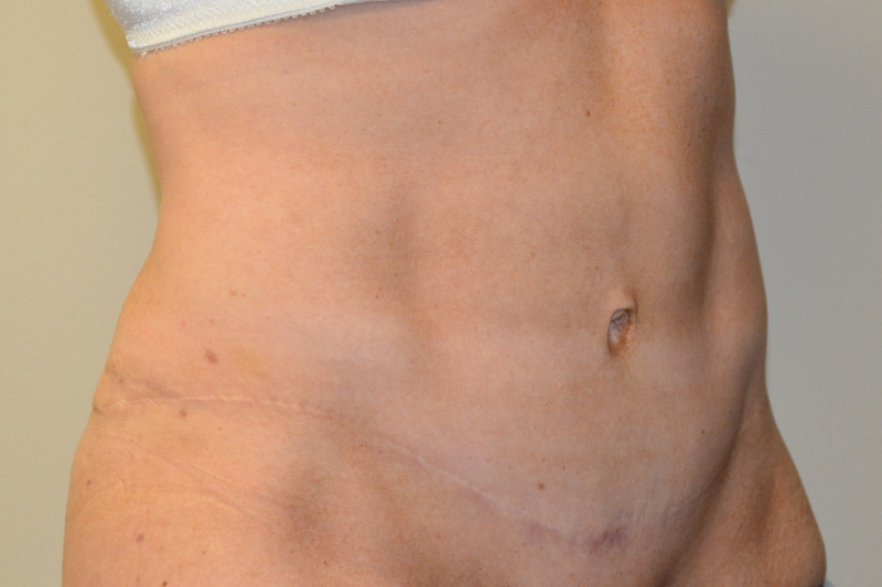 Tummy-Tuck-15 | After Tummy Tuck 4