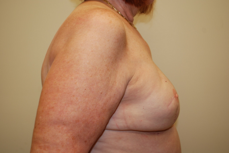 Breast-Reconstruction-Tissue-Expander-12 | After Breast Reconstruction Tissue Expanders 5