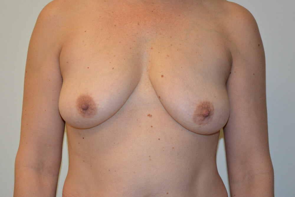 Breast-Lift-13 | Before Breast Lift
