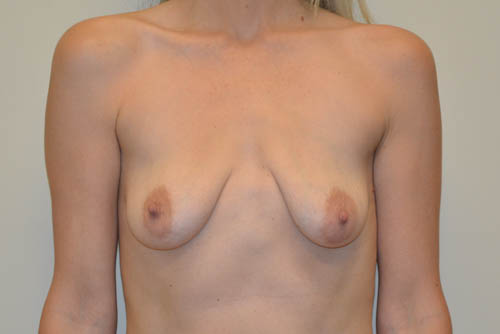 Breast-Lift-and-Augmentation-13 | Before Breast Lift and Augmentation