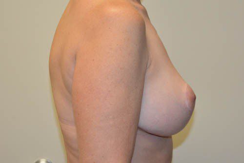Breast-Reduction-13 | After Breast Reduction 3