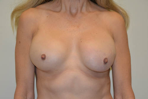 Breast-Revision-13 | Before Breast Revision