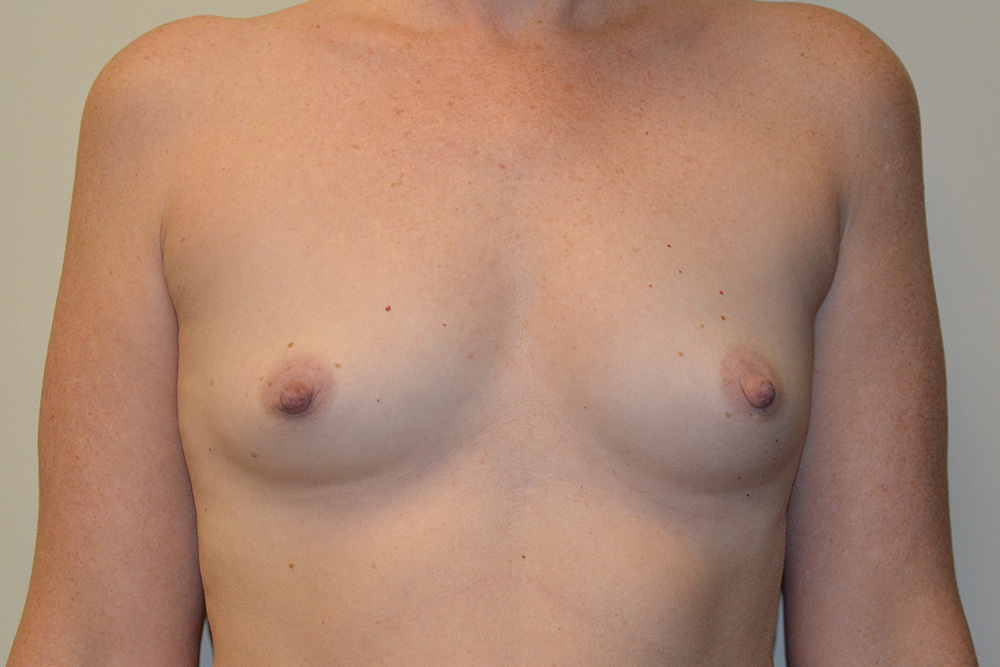 Breast-Augmentation-13 | Before Breast Augmentation
