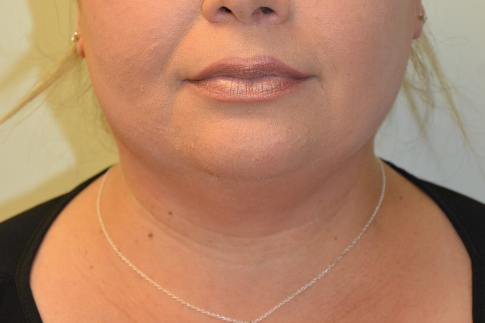 Neck-Liposuction-01 | Before Neck Liposuction