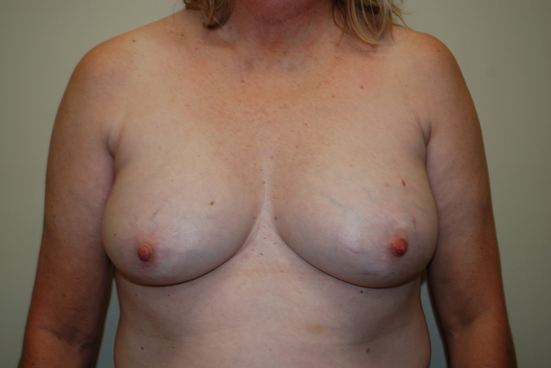 Breast-Reconstruction-Tissue-Expander-13 | Before Breast Reconstruction Tissue Expanders