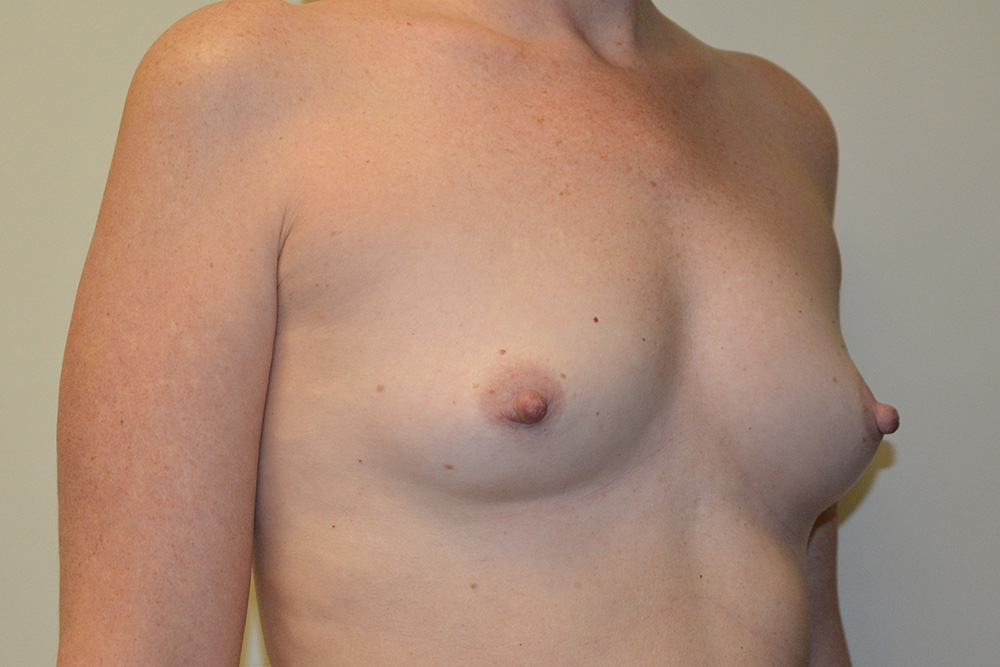 Breast-Augmentation-13 | Before Breast Augmentation 2