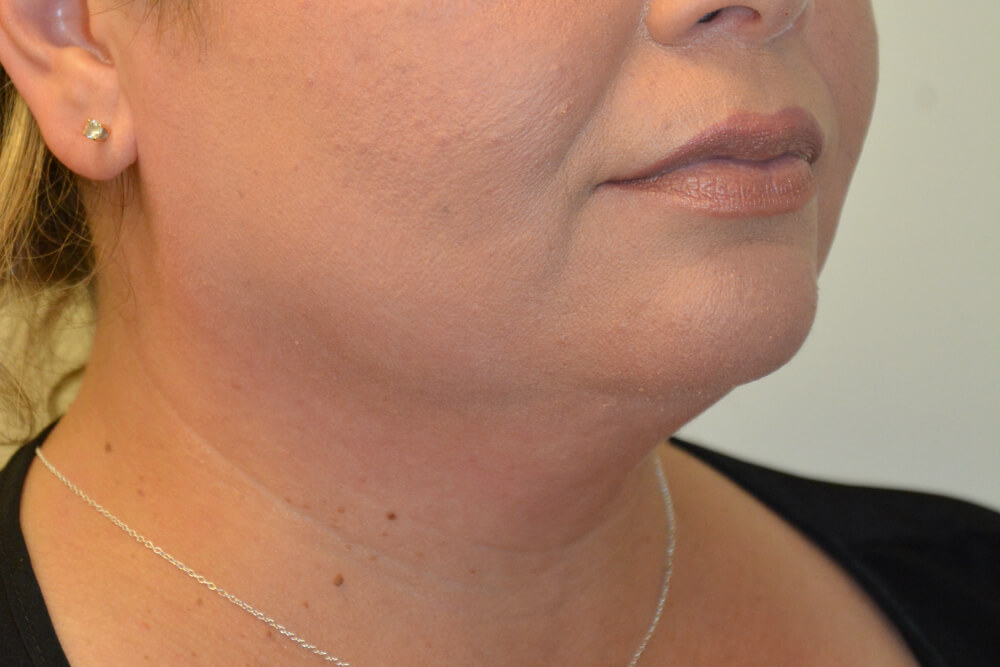 Neck-Liposuction-01 | Before Neck Liposuction 2