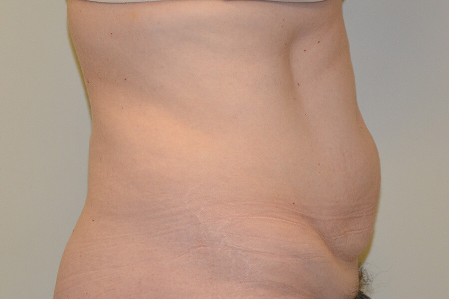 Tummy-Tuck-07 | Before Tummy Tuck 3