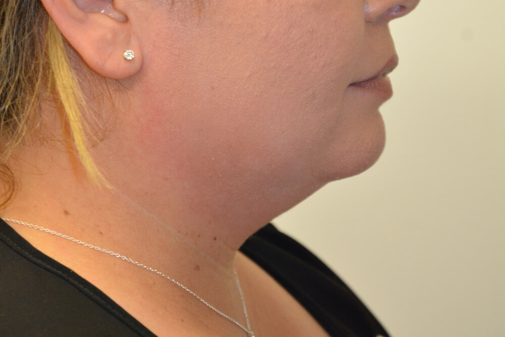 Neck-Liposuction-01 | Before Neck Liposuction 3