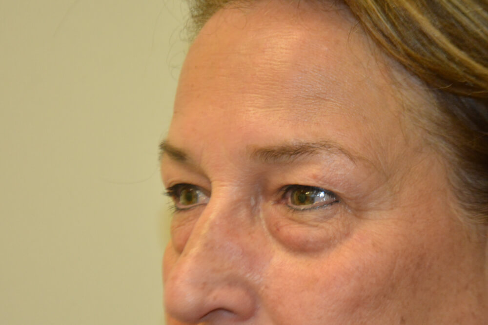 Eyelid-Surgery-13 | Before Eyelid Surgery 4