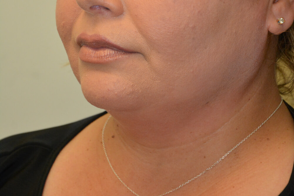 Neck-Liposuction-01 | Before Neck Liposuction 4