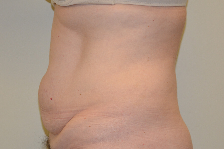 Tummy-Tuck-07 | Before Tummy Tuck 5