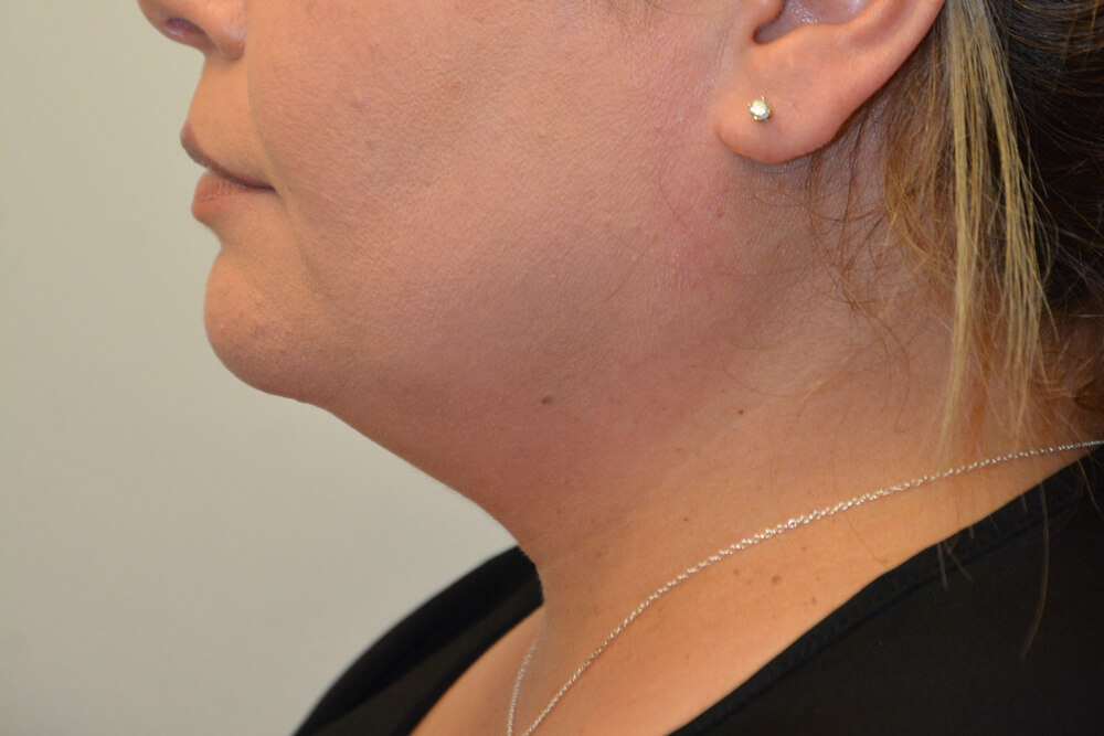 Neck-Liposuction-01 | Before Neck Liposuction 5